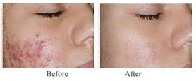 Pimples / Acne 1