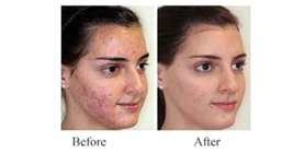 Pimples / Acne 3
