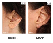 Ear Lobe Repair 1