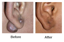 Ear Lobe Repair 2