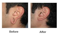 Ear Lobe Repair 3