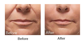 Facial Contouring — Fillers 1