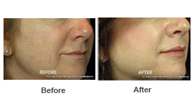 Facial Contouring — Fillers 2