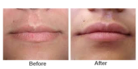 Facial Contouring — Fillers 3