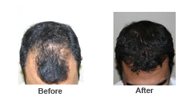 Male Pattern Hair Loss 1