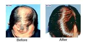 Hair restoration