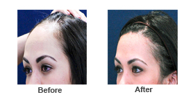 hair restoration