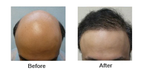 hair restoration