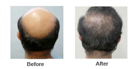 hair restoration