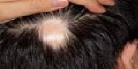 Patchy Hair Loss 1