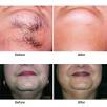 Patchy Hair Loss 2