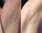 Laser Hair Removal 1
