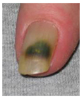 Recurrent Nail Infection 1