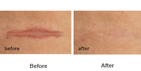 Scars 1