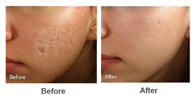 Scars 3