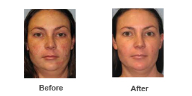 Skin Rejuvenation 1