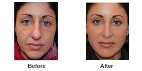Skin Rejuvenation 2