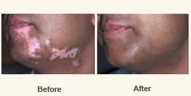 White Patches (Vitiligo) 1