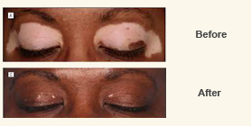 White Patches (Vitiligo) 2