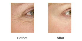 Wrinkle Reduction — Botox 1