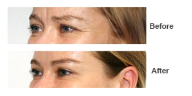 Wrinkle Reduction — Botox 2