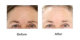 Wrinkle Reduction — Botox 3